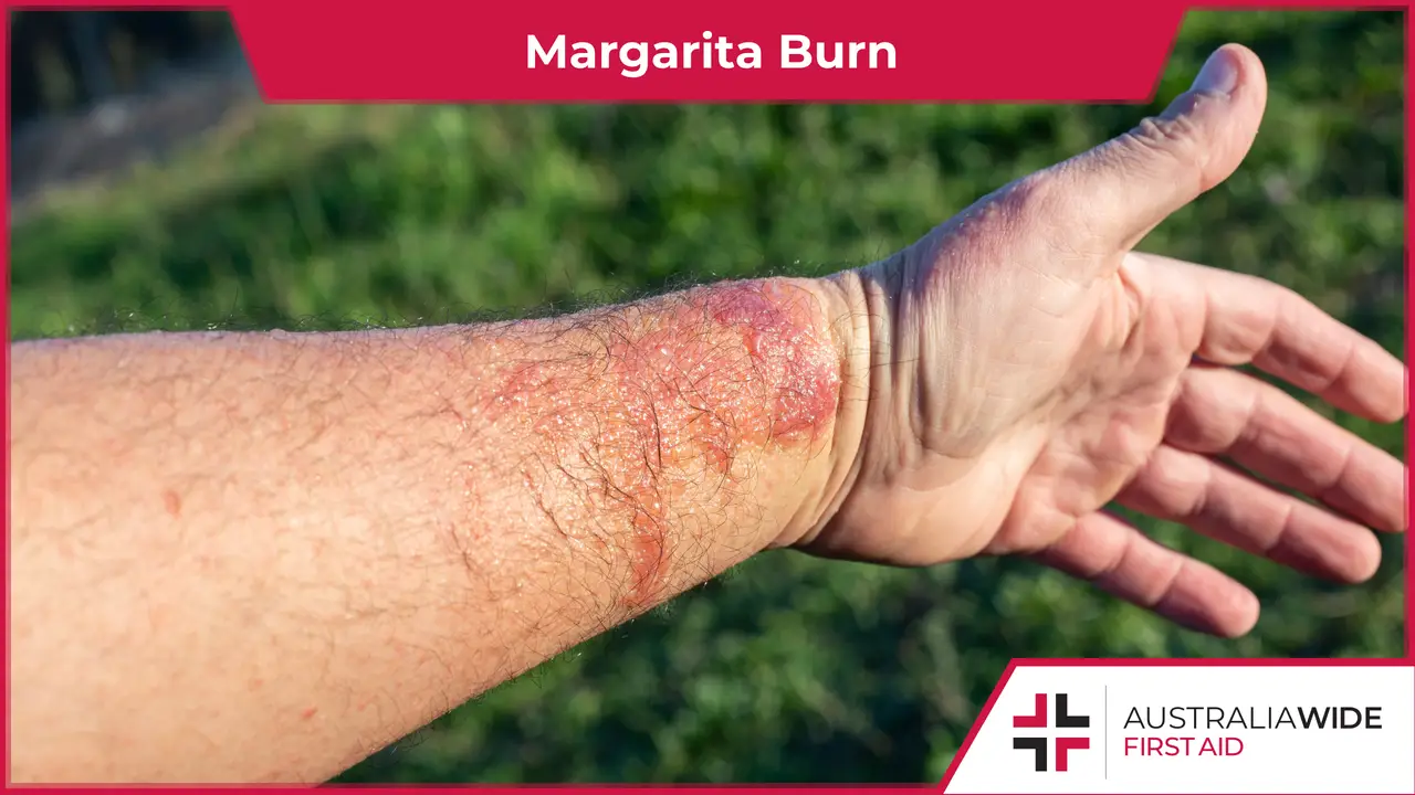 A man's arm with a superficial burn